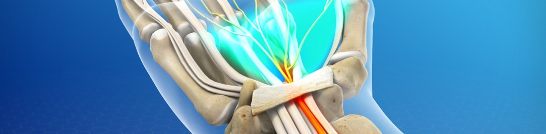 carpaltunnel  1083